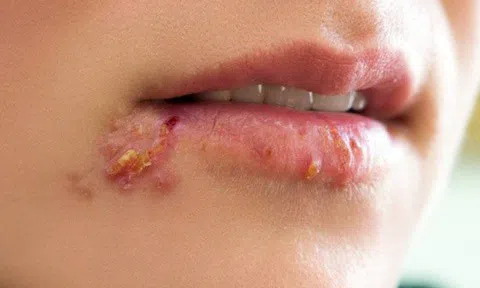 Những biến chứng nguy hiểm của bệnh giời leo