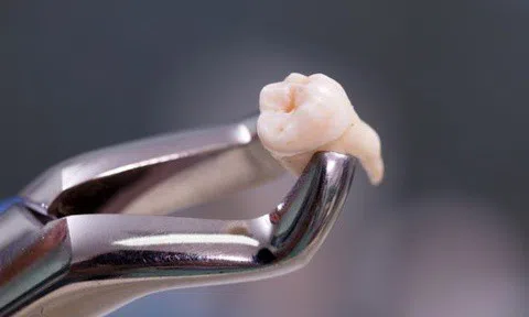 Người phụ nữ tại Trung Quốc tử vong sau khi nhổ 20 chiếc răng