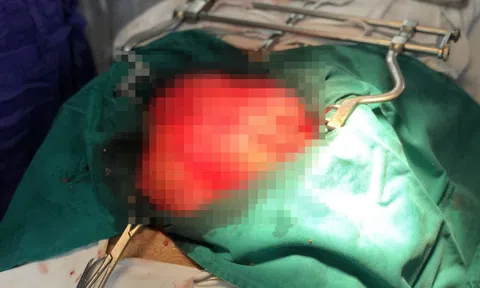 Người đàn ông 2 lần tái phát khối u khổng lồ