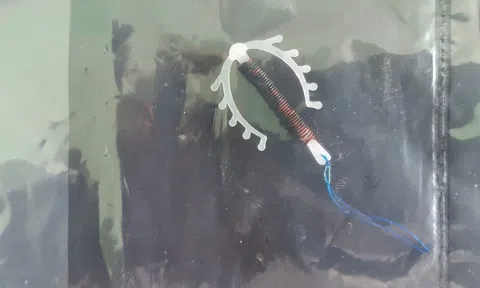 Vòng tránh thai nằm trong tử cung suốt 18 năm