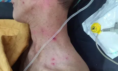 Hai cha con bị ong đốt phải nhập viện cấp cứu