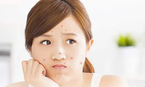 Cải thiện da mụn ở tuổi dậy thì, chuyện tưởng khó nhưng hóa ra dễ